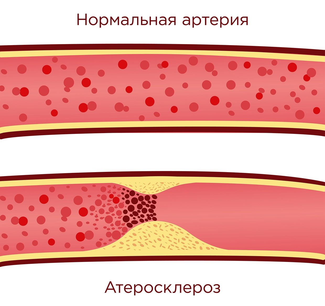 Лечение артериальной гипертонии бесплатно по ОМС